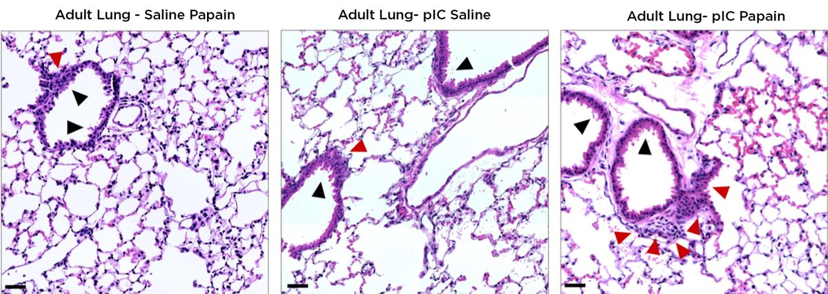 Histopathological images of lungs from adult mice treated either with the allergen papain as adults (left), exposed to an inflammatory stimulus in utero without adult papain treatment (middle), or exposed to prenatal inflammation and treated with papain. Prenatal inflammation and papain individually cause thickening of airway lining, visualized by increased purple and pink staining, and this is worsened with the combined treatment. Histopathological images of lungs from adult mice treated either with the allergen papain as adults (left), exposed to an inflammatory stimulus in utero without adult papain treatment (middle), or exposed to prenatal inflammation and treated with papain. Prenatal inflammation and papain individually cause thickening of airway lining, visualized by increased purple and pink staining, and this is worsened with the combined treatment.