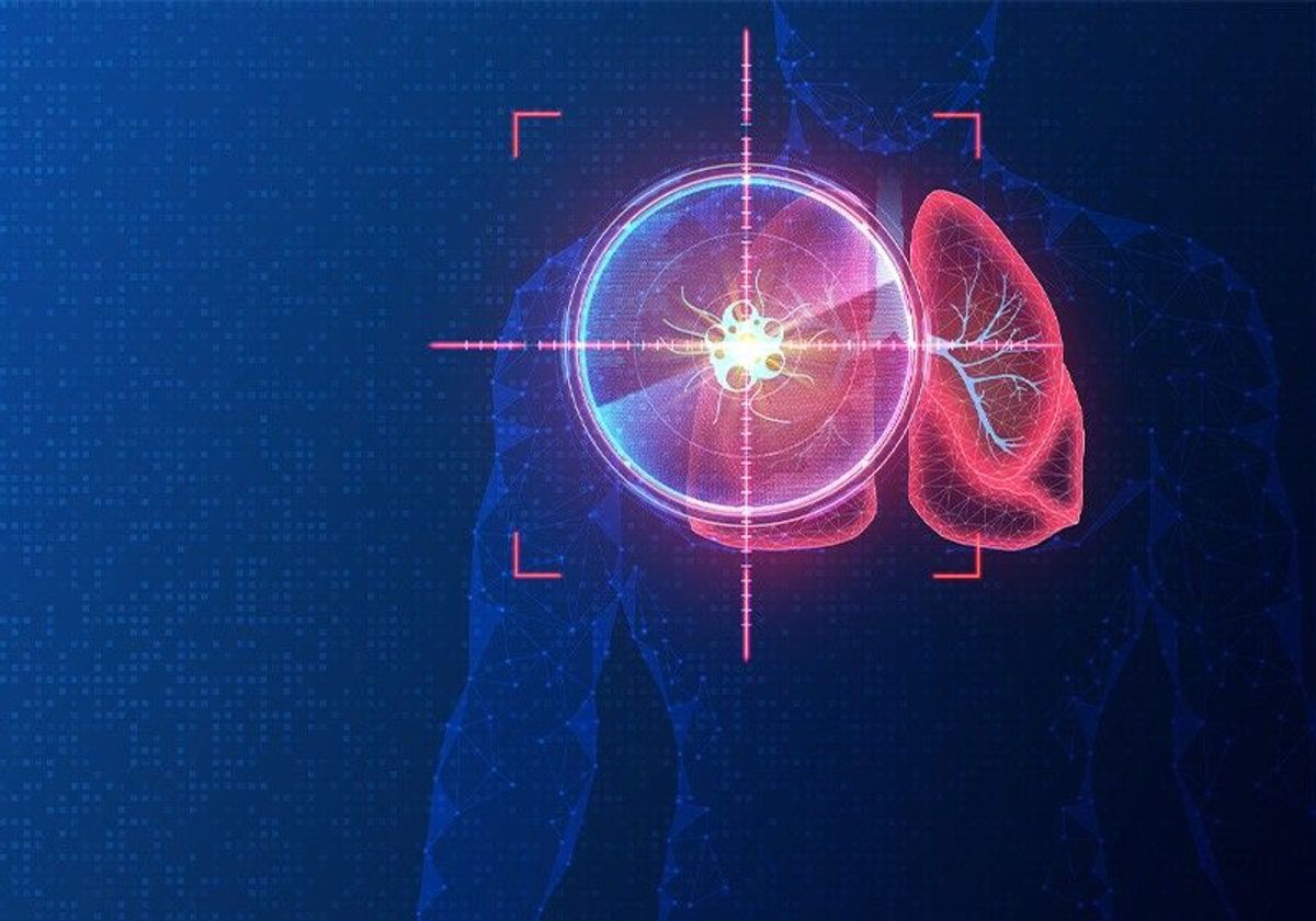 A red target sits over a lung tumor on the outline of a person. A red target sits over a lung tumor on the outline of a person.