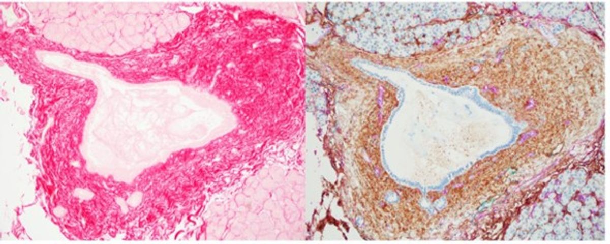 Histopathological cross sections of human pancreas tissue showing red and brown stains for collagen and hyaluronic acid, respectively. Histopathological cross sections of human pancreas tissue showing red and brown stains for collagen and hyaluronic acid, respectively.