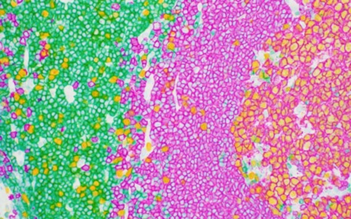 Triple chromogenic IHC of normal colon tissue stained with antibodies to CD3 (green), CD20 (purple), and Ki67 (yellow), 40X magnification. Triple chromogenic IHC of normal colon tissue stained with antibodies to CD3 (green), CD20 (purple), and Ki67 (yellow), 40X magnification.