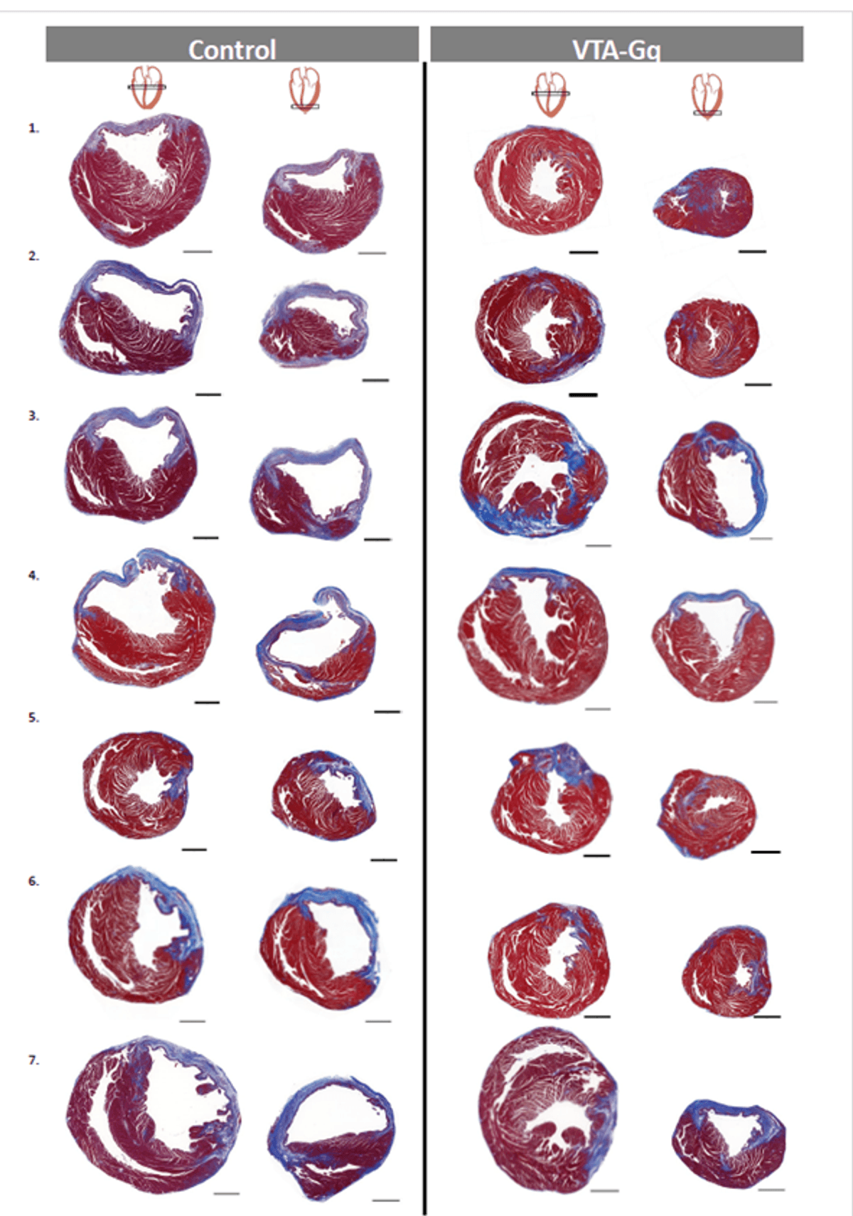 Several cross-sections of blue and red heart tissue are shown, indicating areas of fibrosis and muscle tissue. Several cross-sections of blue and red heart tissue are shown, indicating areas of fibrosis and muscle tissue.
