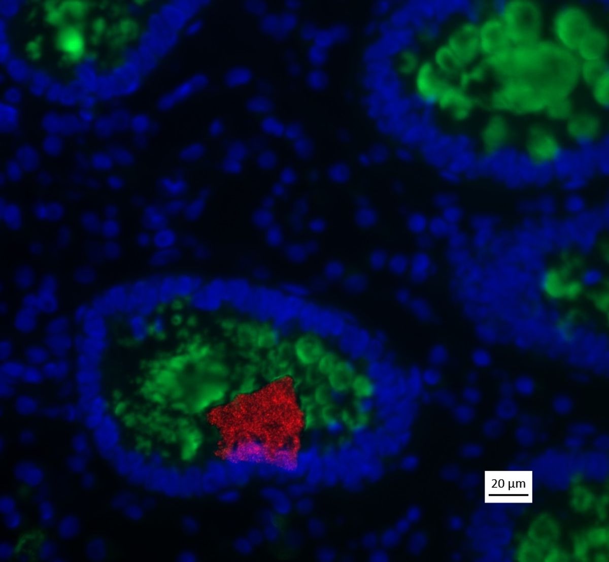A fluorescent microscopy image of periappendicular bowel shows a group of red-labeled bacteria cells embedded in a rough oval of green-labeled mucus tissue, encased in a ring of blue-labeled epithelial cells. A fluorescent microscopy image of periappendicular bowel shows a group of red-labeled bacteria cells embedded in a rough oval of green-labeled mucus tissue, encased in a ring of blue-labeled epithelial cells.
